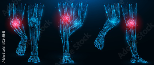 Polygonal vector illustration of human legs, inflammatory disease of the knee joint concept. Low poly art lower limbs on a dark blue background.