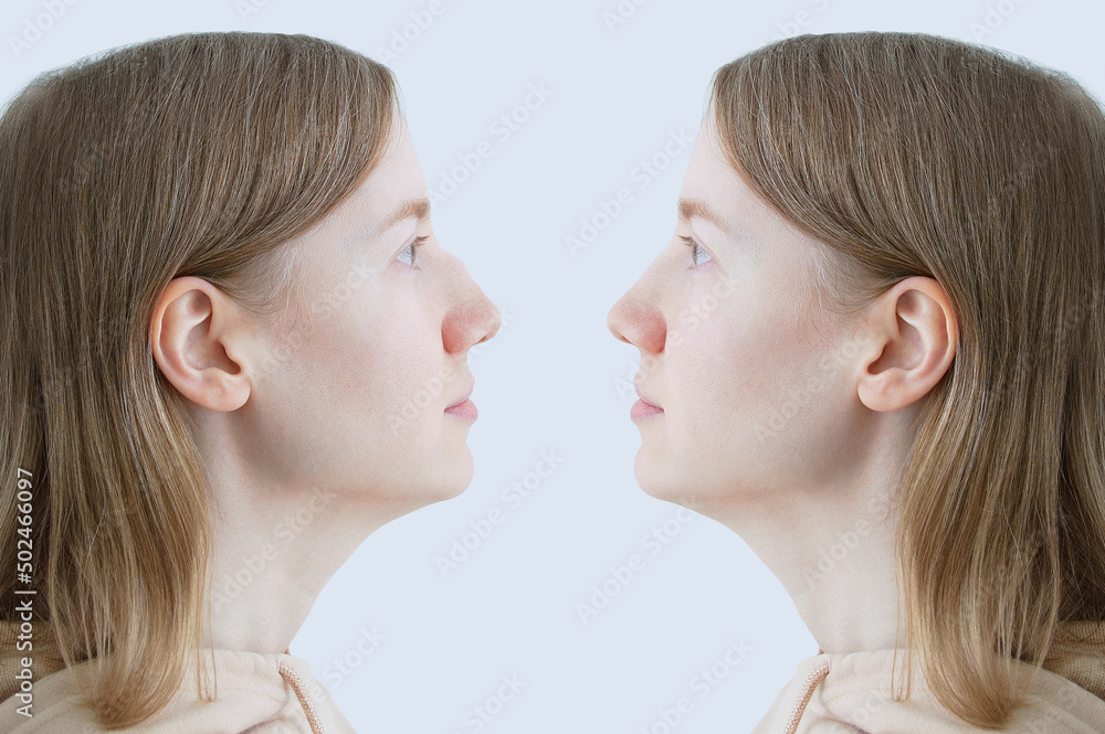 Aquiline nose. caucasian woman. Before and after. Aquiline nose. caucasian woman. Before and after.