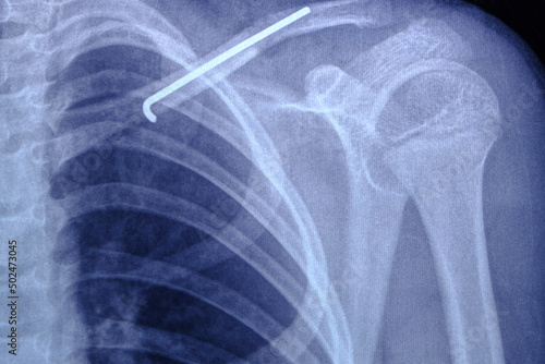 X ray image person with broken collarbone and spoke installed in it after surgery.