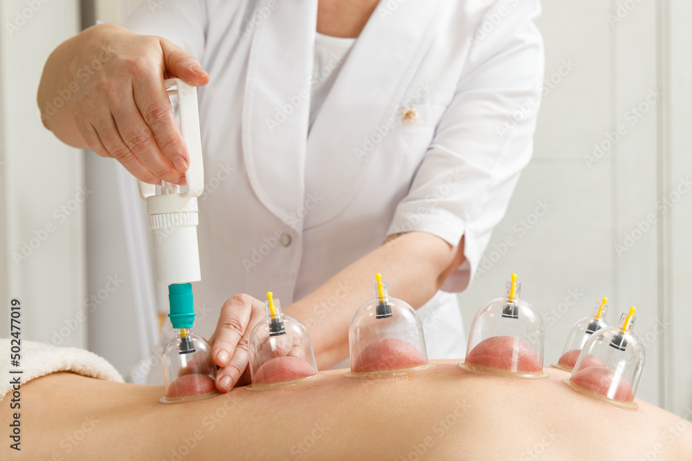 Vacuum massage. Vacuum cups of medical cupping therapy on woman back, close up, chinese medicine. Vacuum massage. Vacuum cups of medical cupping therapy on woman back, close up, chinese medicine.