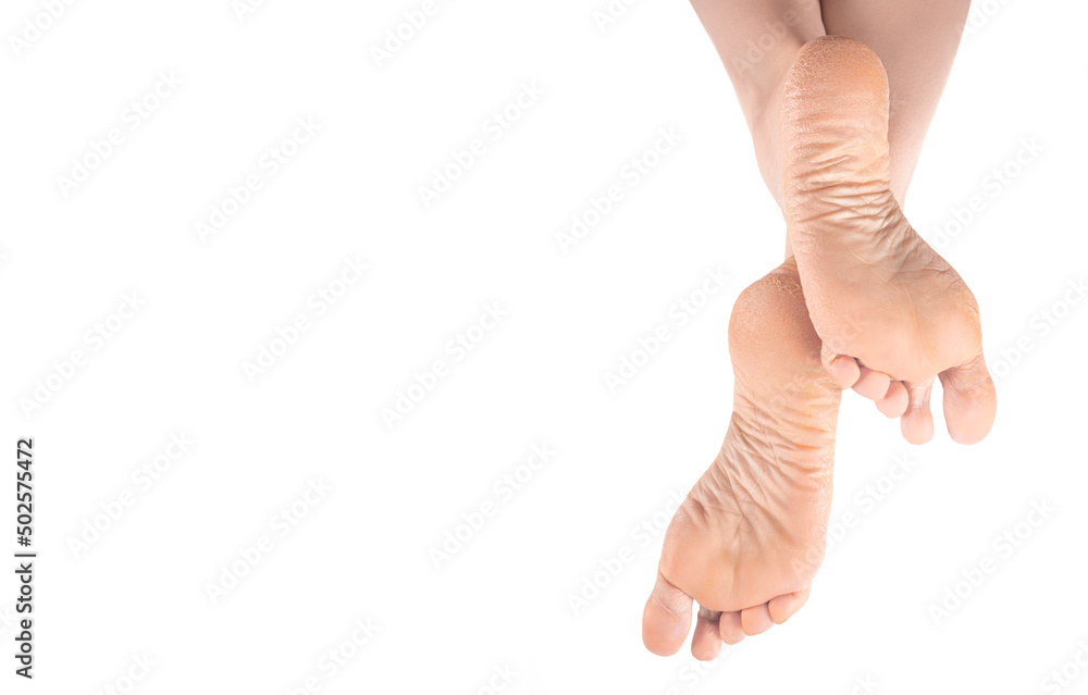 Dry and cracked soles of feet. female legs, feet, foot in an elegant