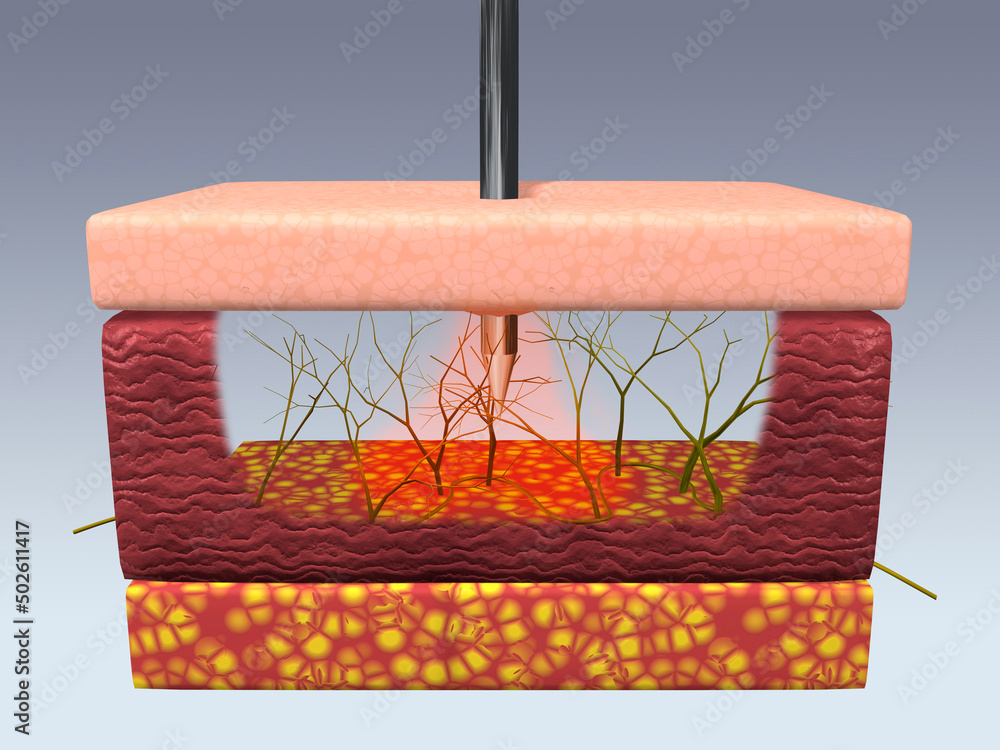 Cross section of skin nerve cells feeling pain of a pin prick Stock Illustration Adobe Stock