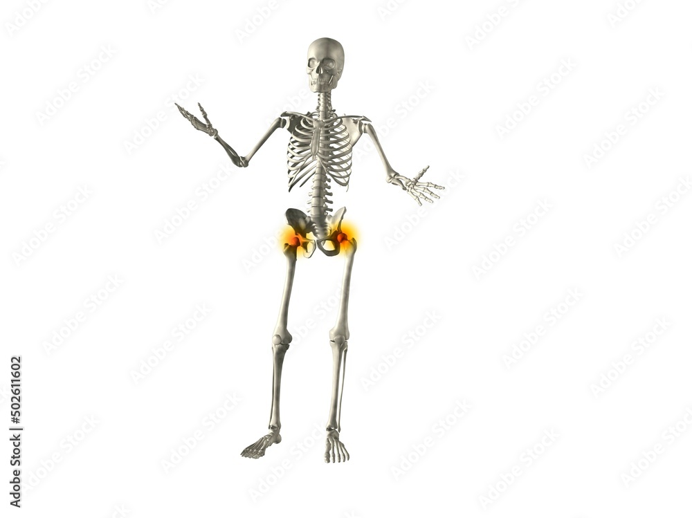 X-ray view of a human skeleton with hip joint inflammation X-ray view of a human skeleton with hip joint inflammation