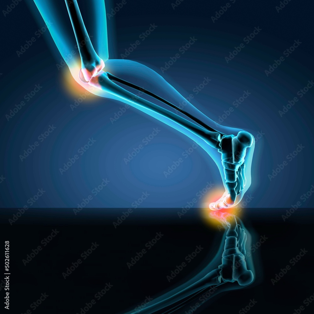 X-ray view of a human's leg showing pain in knee, ankle and foot in ...