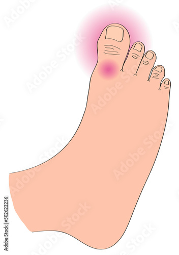Close-up of foot with gout photo