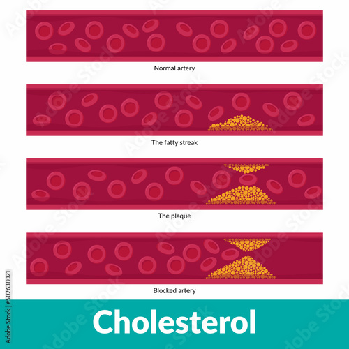Scheme of clogged artery development with visualized blood stream