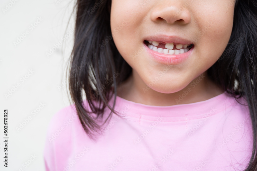 kid broken tooth, asian girl smiling kid broken tooth, asian girl smiling