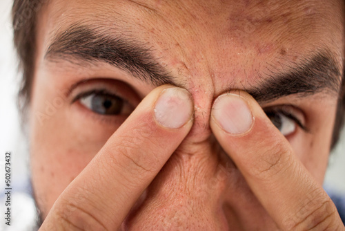 Close-up of male aggressively popping a zit between his eyes