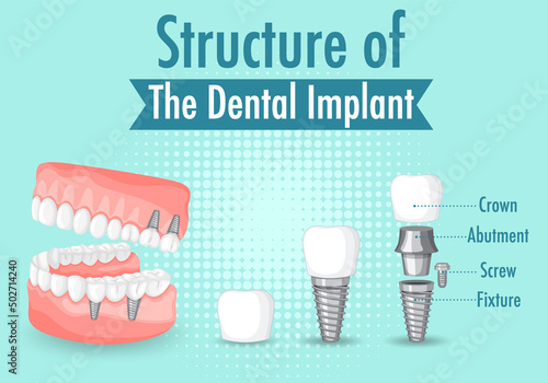 Infographic of human in structure of the dental implant