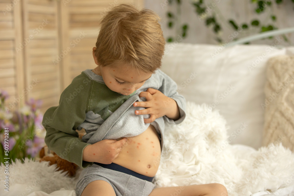 Toddler boy with chicken pox,lying in bed with fever, mother checking him Toddler boy with chicken pox,lying in bed with fever, mother checking him
