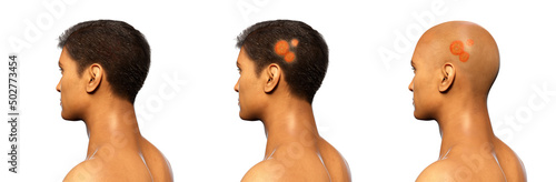 Fungal infection on a man's head, 3D illustration photo