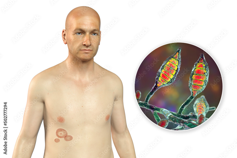 Fungal infection on a man's body. Tinea corporis, 3D illustration Stock ...