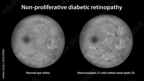 Non-proliferative diabetic retinopathy, illustration photo