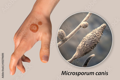 Fungal infection on a man's hand. Tinea manuum and close-up view of dermatophyte fungi photo