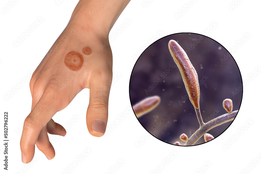 Fungal infection on a man's hand. Tinea manuum and close-up view of  dermatophyte fungi, 3D illustration Stock Illustration