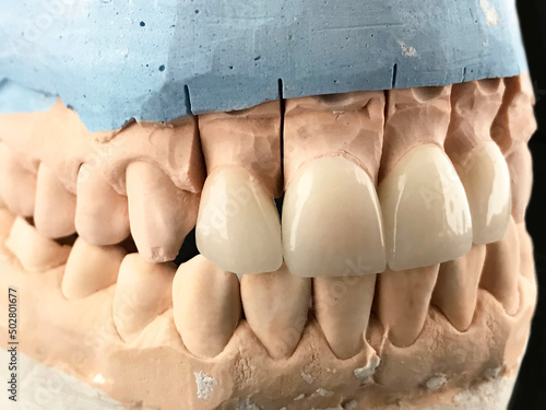 Dental zirconia crowns in the plaster model. White front teeth veneers on diagnostic model on dark background. Closeup of dental prosthesis porcelain teeth in a mold. Dental clinic. photo