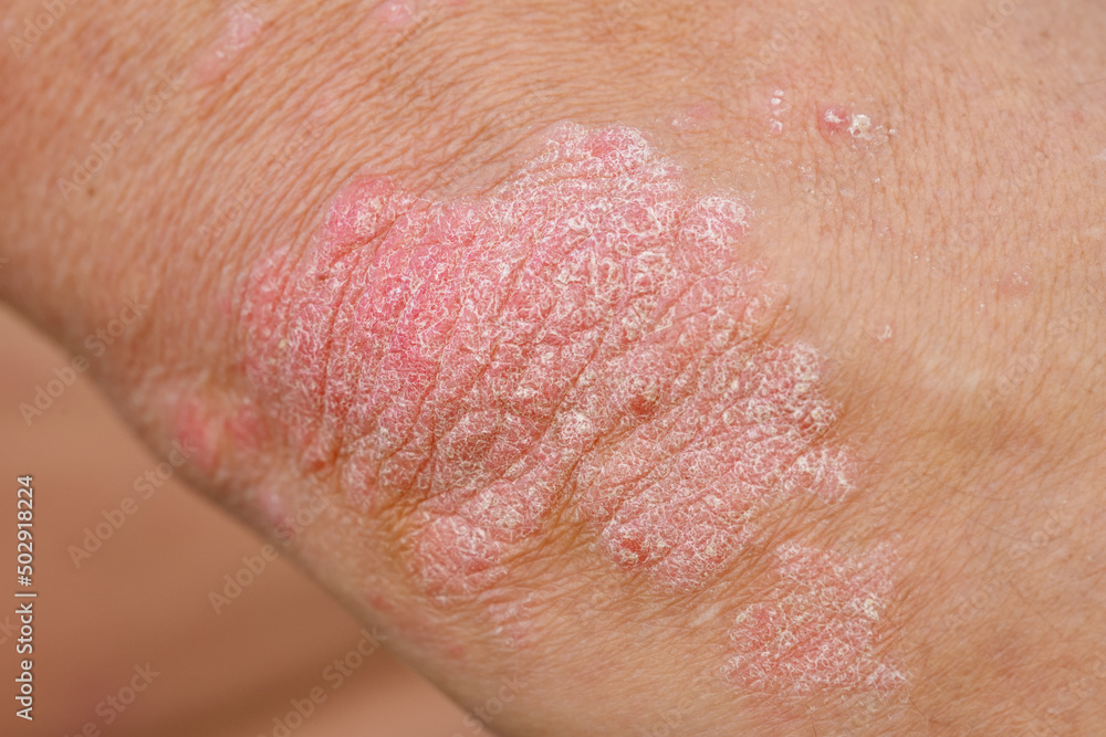 Fototapeta premium Manifestation of psoriasis on the skin of the elbow