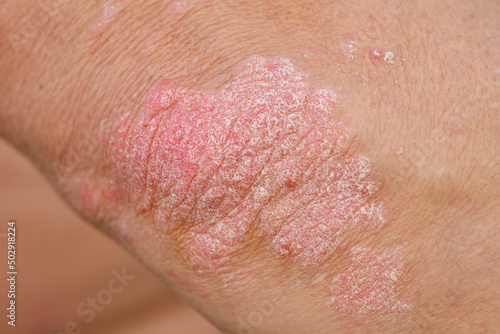 Manifestation of psoriasis on the skin of the elbow photo
