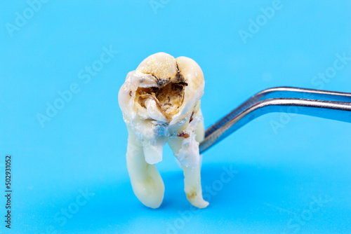 Fototapeta Naklejka Na Ścianę i Meble -  Human wisdom tooth in tweezers with four roots, one root broken during removal isolated on blue background.