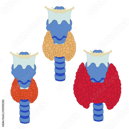 thyroid gland in three states is isolated on a white background. Image of Hypothyroidism, disease for Medical centers, education. World Thyroid Day