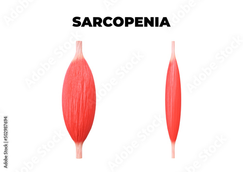 Sarcopenia is the loss of muscle mass, a common occurrence after age 50 photo