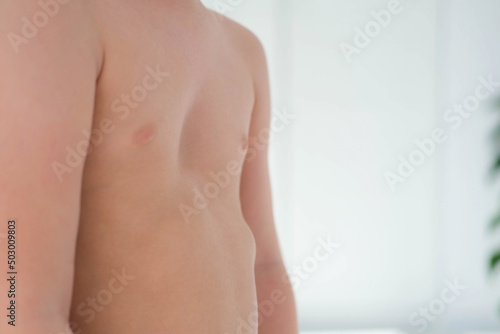 A child with a pectus excavatum. Rickets is a consequence of vitamin D deficiency.