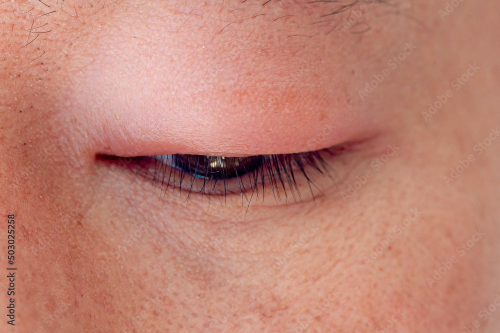 Health and skincare concept, Close up narrow-eyed asian style, Chalazion and Hordeolum (Stye) are sudden-onset localized swelling of the eyelid, Swollen eye caused by inflammation with selective focus