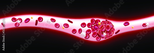 3D illustration of a blood clot in a blood vessel showing a blocked blood flow with platelets and white blood cells in the image. medical use education and science