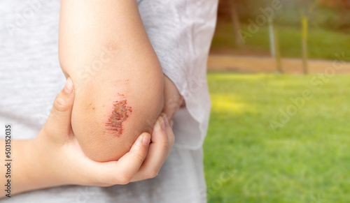 Close up of a child showing an elbow injury outdoors