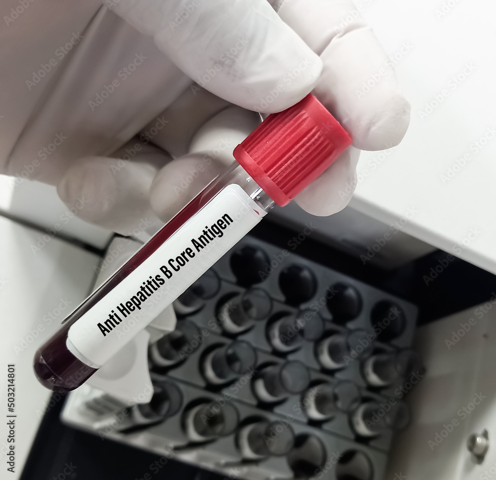 Test Tube with blood sample for Anti Hepatitis B core(AHBC) antigen test. A medical testing concept. Test Tube with blood sample for Anti Hepatitis B core(AHBC) antigen test. A medical testing concept.