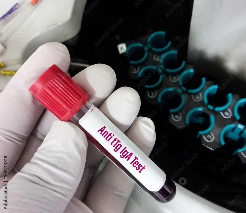 Blood Sample for Anti tTg(Tissue transglutaminase) IgA test, diagnosis