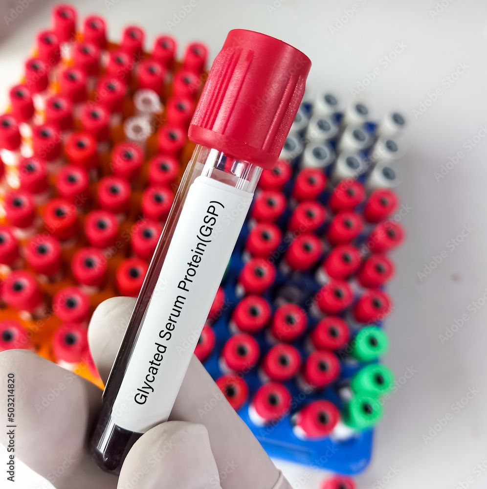 Blood sample for Glycated Serum Protein(GSP) test or Fructosamine test