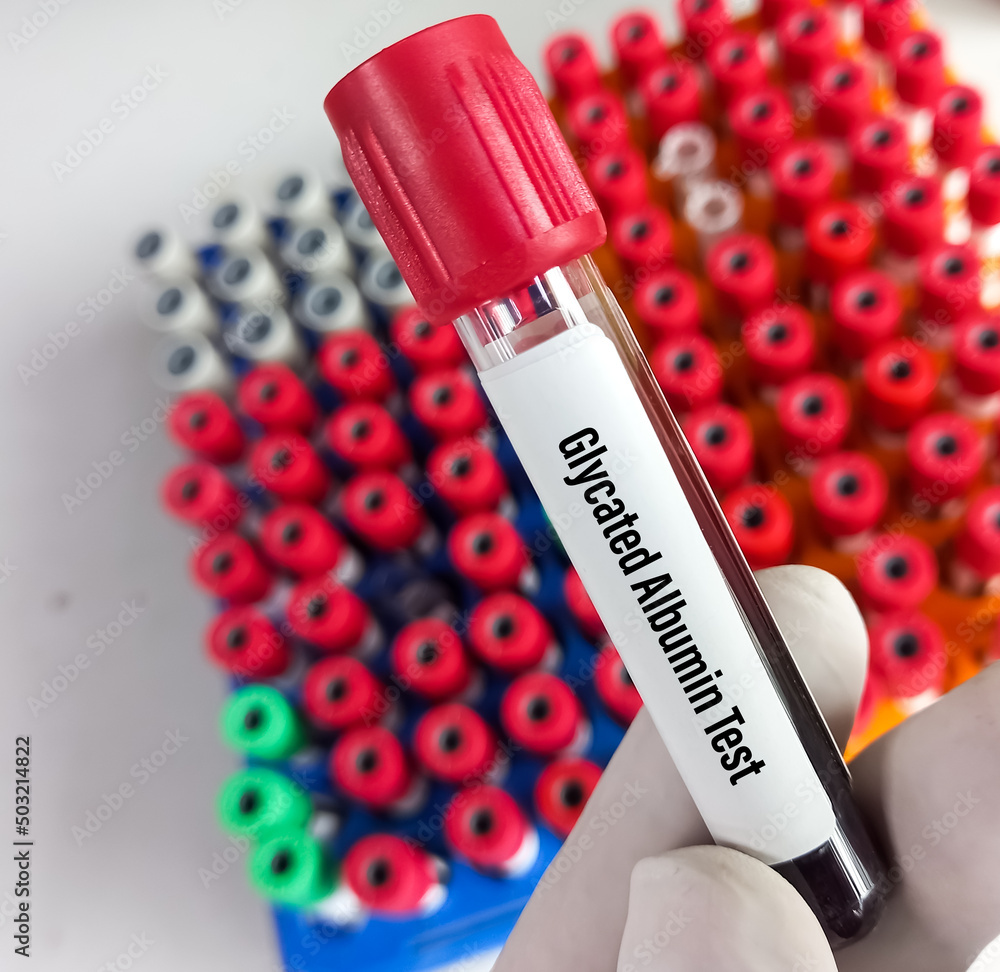 Foto de Blood sample for Glycated Albumin test or Fructosamine test