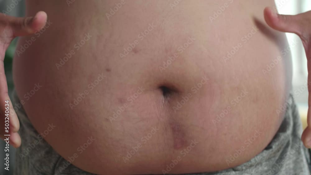 Close Up Of Fat Man Pinch Excess Fat That Has Around His Waist
Close Up Of Fat Man Pinch Excess Fat That Has Around His Waist