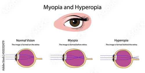 illustration of medical and biology, Myopia and Hyperopia, vision problems, blurry vision, Myopia Symptoms, Astigmatism