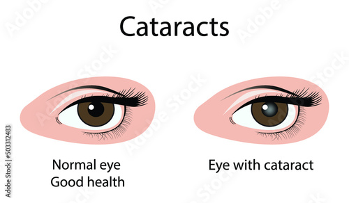 illustration of biology and medical, cataract is a cloudy area in the lens of the eye that leads to a decrease in vision, blindness, visual impairment