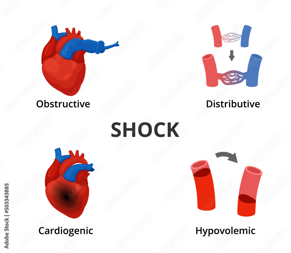4 Types Of Shock Diagram Medical Emergency Infographics Stock Vector 