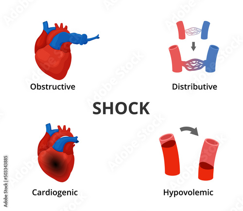 4 types of shock diagram. Medical emergency infographics photo