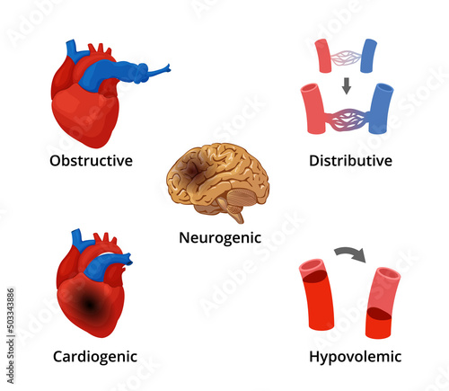 5 types of shock infographics. The diagram with the illustrations of five types of shock