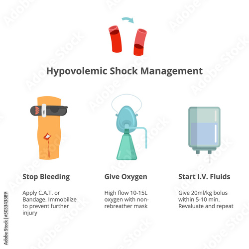 Hypovelemic shock managment. Shock management options
