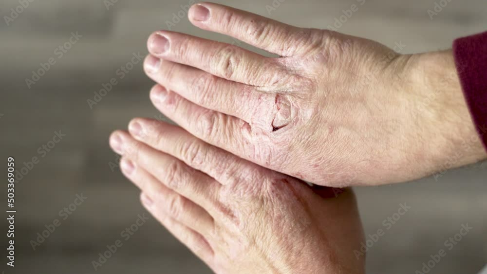Old Person Showing His Hands Dry Skin With Some Wounds And Scratches. - Closeup Old Person Showing His Hands Dry Skin With Some Wounds And Scratches. - Closeup