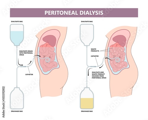 dialysate cleansing home care tube fluid drain bag waste High blood cysts center manual port End Stage renal ESRD Infusion Diffusion fatty liver tap cancer B C Use pain cavity portal peritoneocentesis