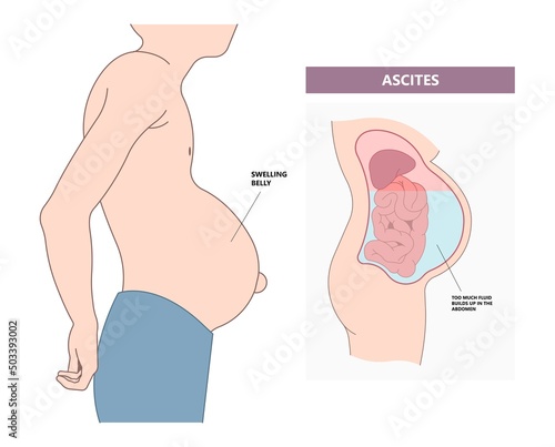 dialysate cleansing home care tube fluid drain bag waste High blood cysts center manual port End Stage renal ESRD Infusion Diffusion fatty liver tap cancer B C Use pain cavity portal peritoneocentesis