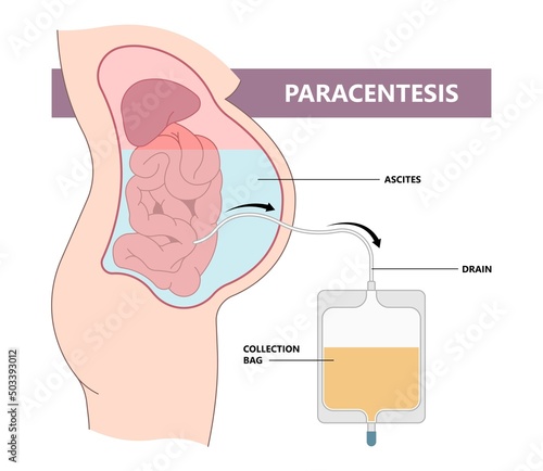 dialysate cleansing home care tube fluid drain bag waste High blood cysts center manual port End Stage renal ESRD Infusion Diffusion fatty liver tap cancer B C Use pain cavity portal peritoneocentesis