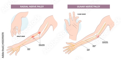 Pronator teres syndrome of nerve palsy carpal tunnel claw hand sport injury pain arm elbow joint ulnar wrist drop distal outlet neuropathies fall Radial motor tendon night Phalen test preacher papal photo