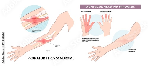 Pronator teres syndrome of nerve palsy carpal tunnel claw hand sport injury pain arm elbow joint ulnar wrist drop distal outlet neuropathies fall Radial motor tendon night Phalen test preacher papal photo