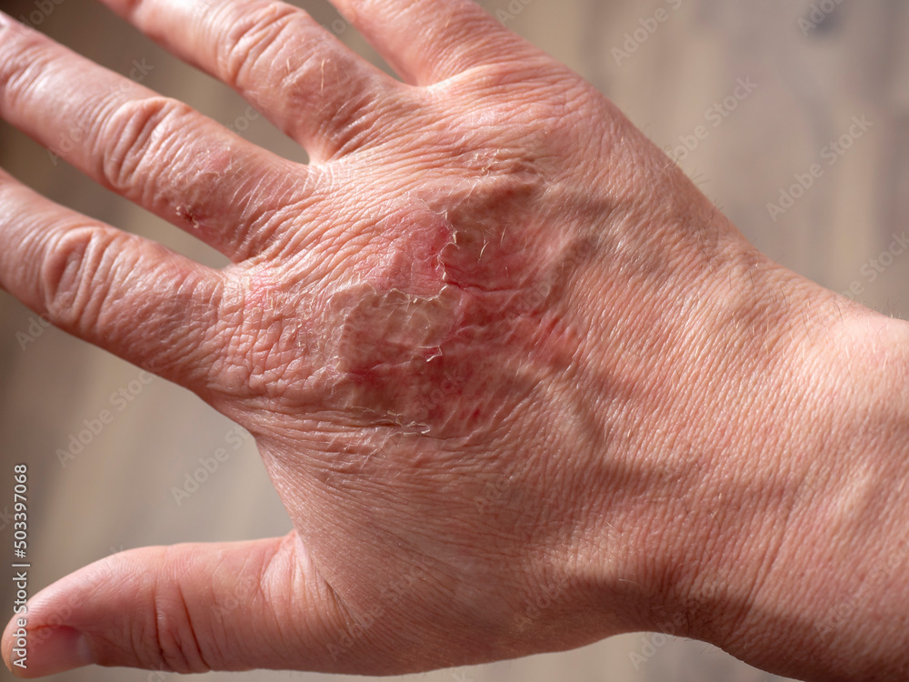 Scars on the skin of the hand after a burn. Healing burns on the arm