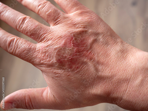 Scars on the skin of the hand after a burn. Healing burns on the arm.