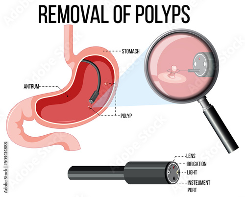 Diagram showing removal of polyps