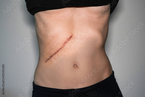 Woman with a large scar after liver surgery